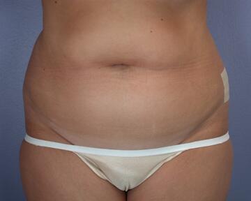 Liposuction Before & After Image