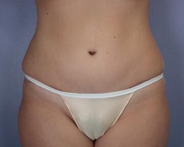 Liposuction Before & After Image