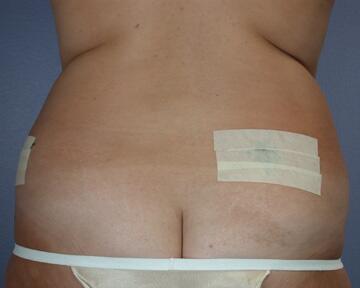 Liposuction Before & After Image