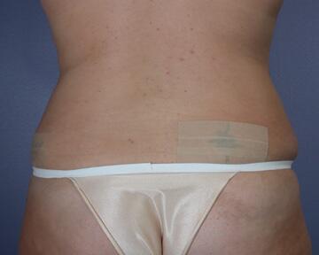 Liposuction Before & After Image