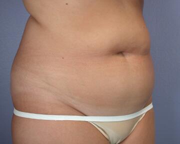 Liposuction Before & After Image