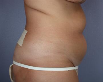 Liposuction Before & After Image