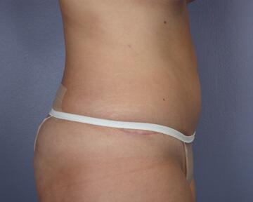 Liposuction Before & After Image