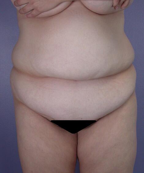 Liposuction Before & After Image