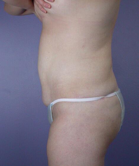 Liposuction Before & After Image