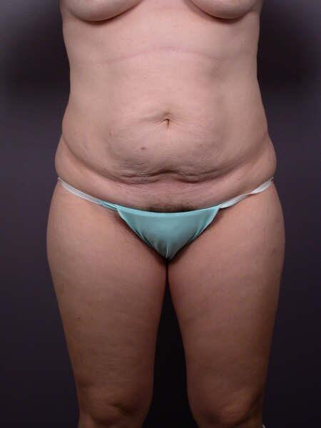 Liposuction Before & After Image