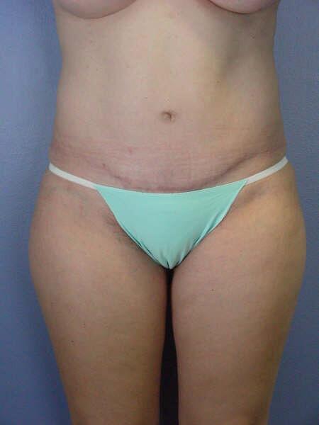 Liposuction Before & After Image