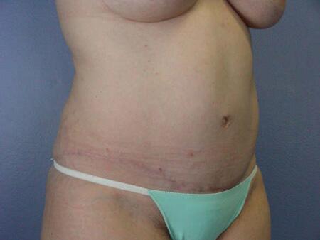 Liposuction Before & After Image