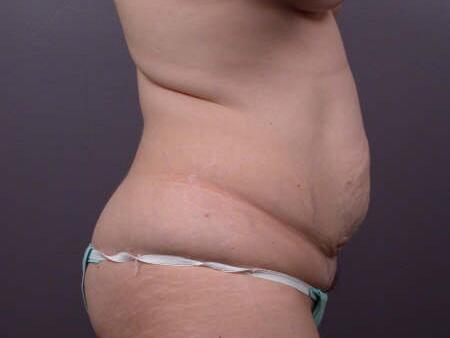 Liposuction Before & After Image