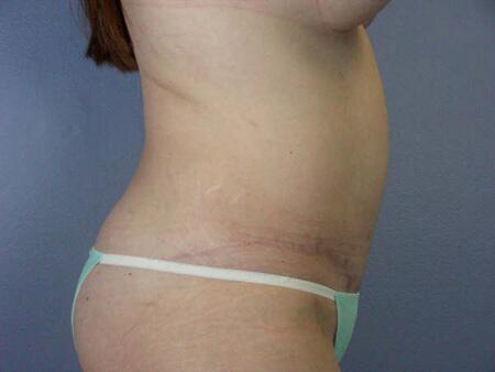 Liposuction Before & After Image