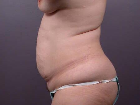 Liposuction Before & After Image