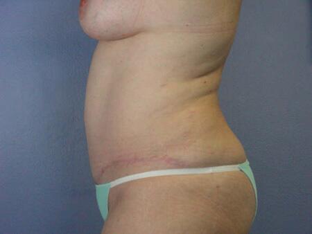 Liposuction Before & After Image