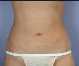 Liposuction Before & After Image