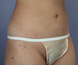 Liposuction Before & After Image