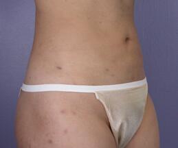 Liposuction Before & After Image