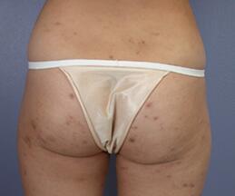 Liposuction Before & After Image