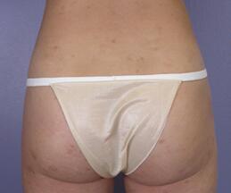 Liposuction Before & After Image