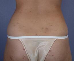 Liposuction Before & After Image