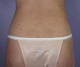 Liposuction Before & After Image