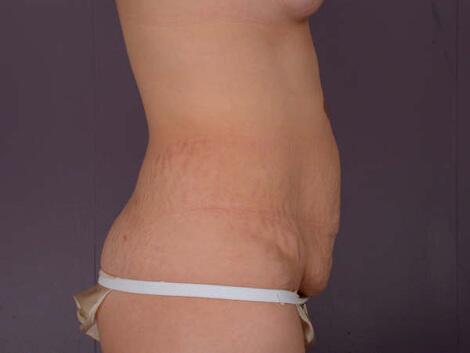 Liposuction Before & After Image