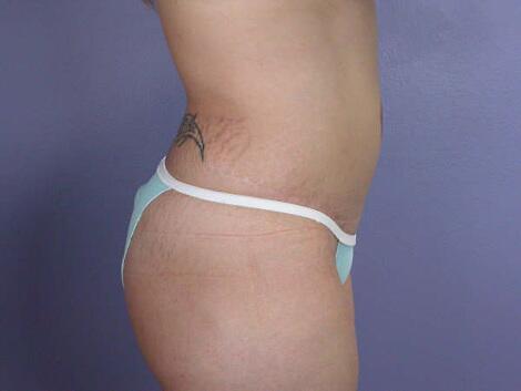 Liposuction Before & After Image