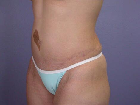 Liposuction Before & After Image