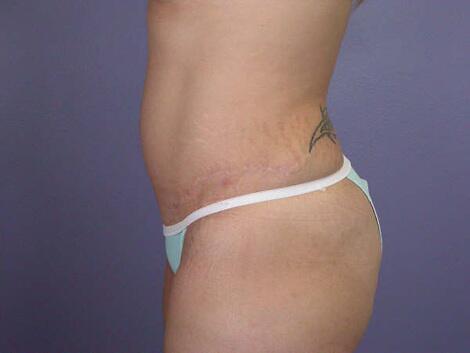 Liposuction Before & After Image