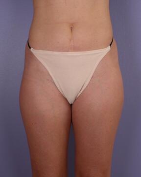 Liposuction Before & After Image