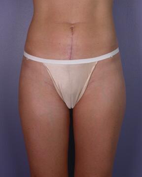 Liposuction Before & After Image