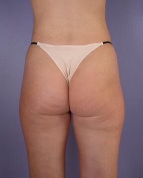 Liposuction Before & After Image