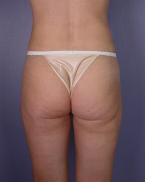 Liposuction Before & After Image