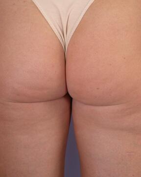 Liposuction Before & After Image