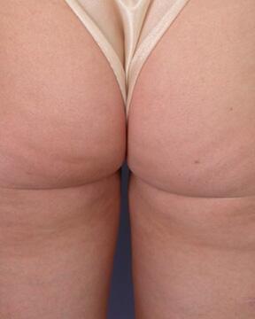 Liposuction Before & After Image