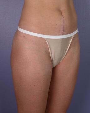 Liposuction Before & After Image