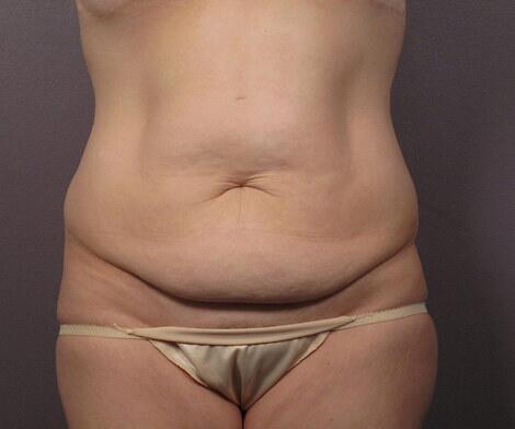 Liposuction Before & After Image