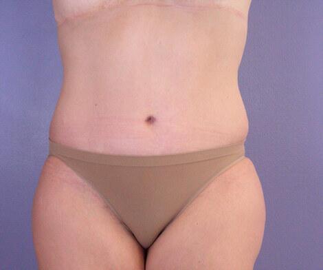 Liposuction Before & After Image