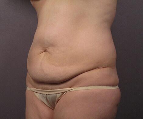 Liposuction Before & After Image