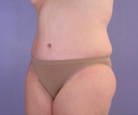 Liposuction Before & After Image