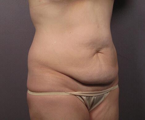 Liposuction Before & After Image