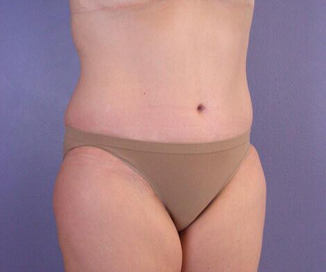 Liposuction Before & After Image