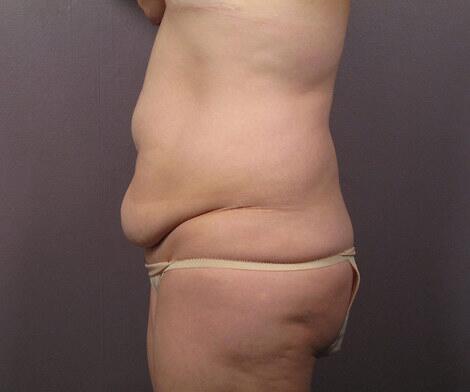 Liposuction Before & After Image