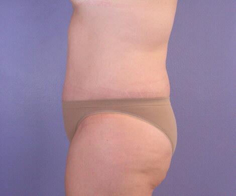 Liposuction Before & After Image