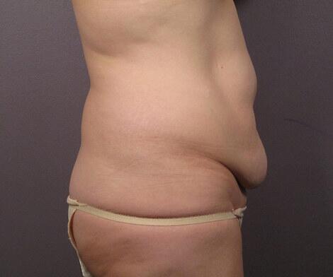 Liposuction Before & After Image