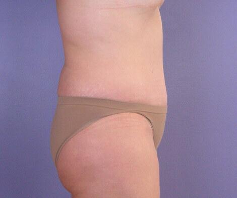 Liposuction Before & After Image