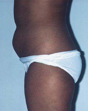 Liposuction Before & After Image