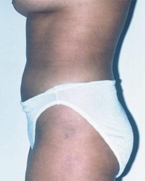 Liposuction Before & After Image