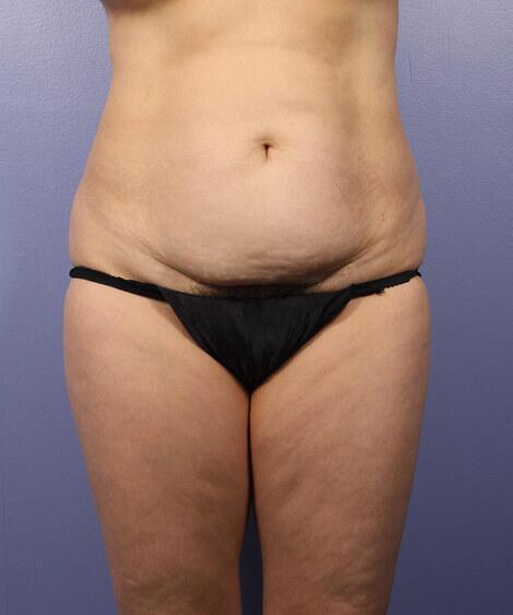 Liposuction Before & After Image