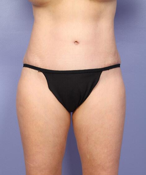 Liposuction Before & After Image