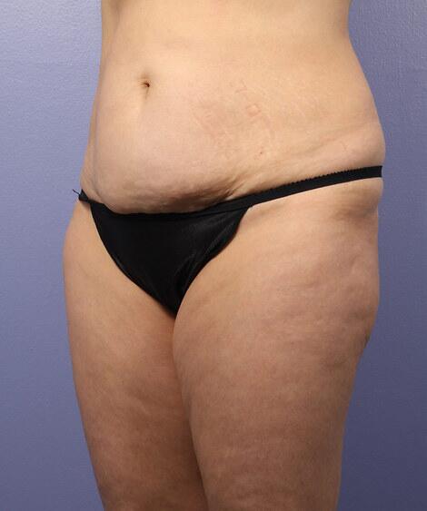 Liposuction Before & After Image