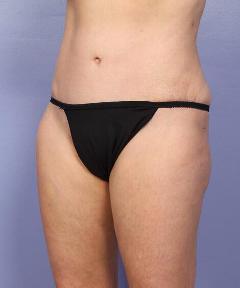 Liposuction Before & After Image